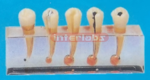 ENDODONTIC DISEASE CLINICAL MODEL